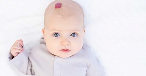 Mon bébé a un angiome, que faire ?