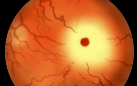 First Gene Therapy for Tay-Sachs Disease Successfully Given to Two Children