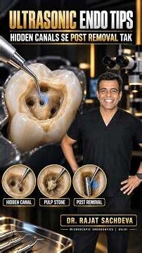 Ultrasonic Endo Tips Ke Diverse Uses | Hidden Canals Se Post Removal Tak #endospecialist #endotips