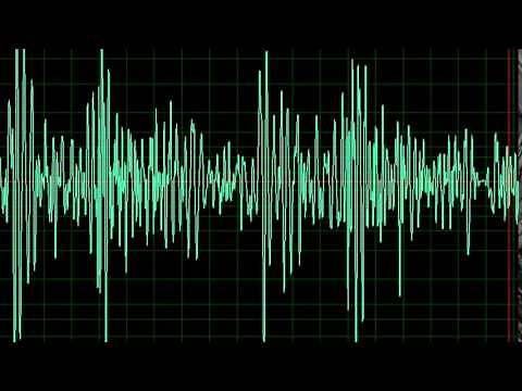 Aortic Regurgitation- normal speed