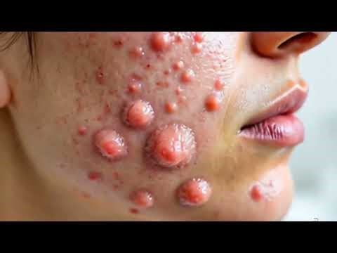 Massive Cyst Explosion 😳