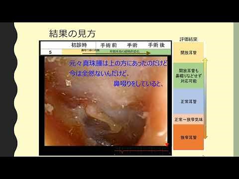 上鼓室型真珠腫における開放耳管の検出と対策- V-TTAGを用いて