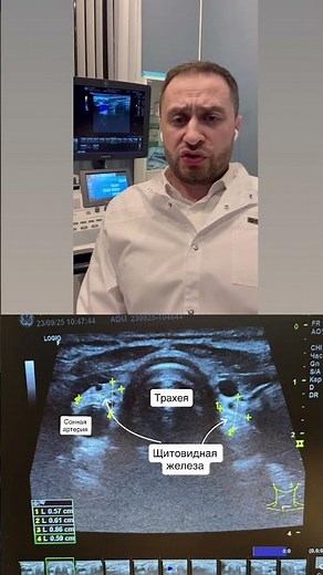 Autoimmune thyroiditis, atrophic form