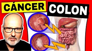 Cáncer de colon (recto) : síntomas, prevención y tratamiento El video trata sobre los síntomas del cáncer de colon y cáncer de recto, y cómo hacer la prevención del cáncer de colon y el cribado. También comento las opciones de tratamiento. Es importante ser consciente de estos síntomas y consultar a un médico si experimenta alguno de ellos. Es importante someterse a los cribados de detección precoz a partir de los 50 años y antes si tienes factores de riesgo. CONTENIDOS 0:00 Cáncer colorrectal e