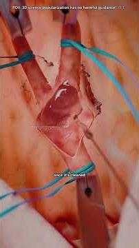 How Carotid Endarterectomy Is Performed(3D Animation)#carotidendarterectomy