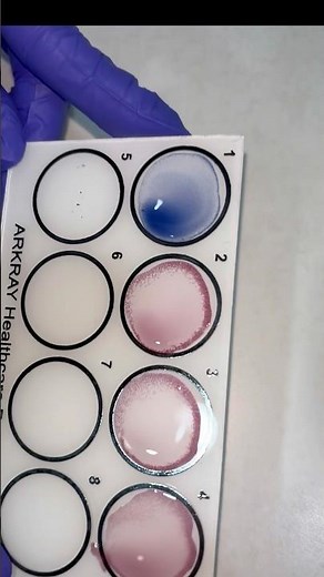 #Widal test #Slide test#Salmonella typhi#Salmonella paratyphi#rapid slide method#Agglutinationreact