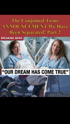 Conjoined Twins Announcement: We Have Been Separated! Part 2