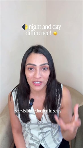 How do I treat long-standing acne scars? A regenerative approach for melanin-rich & South Asian skin