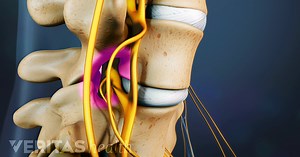 What Is Spinal Stenosis?