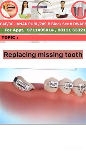 Tooth missing for long time and space is lost? Watch this! #missingteeth #dentist