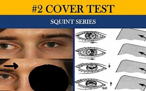 COVER TESTS|Direct, Indirect, Cover-Uncover and Alternate cover - 眼科检查：遮盖试验