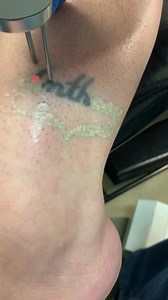 328 reactions · 143 shares | The way a laser removes a tattoo is by...