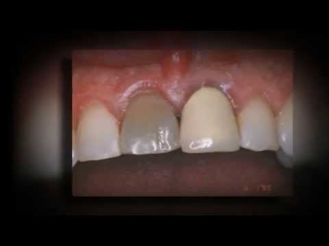 Crowns on Front Teeth