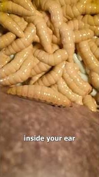 How Maggots Eat Your Eardrum 😨 Surgeon Reacts