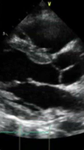 Parasternal Long Axis (PLAX) view in echocardiography. #emergency #echo #cardiology #mbbs #education