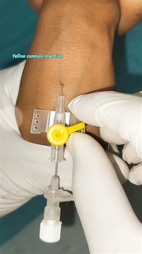 IV Cannula Insertion Technique 💉 | Cannula Kaise Lagate Hain? #shorts #nursing #medical #newshorts