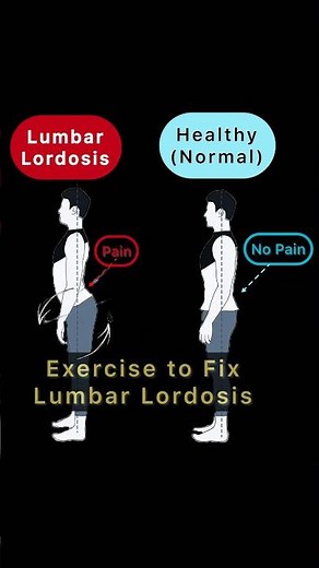 Exercise to fix Lumbar Lordosis. Correct Lumbar Lordosis Posture.