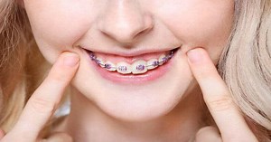 Fake Braces: What Are They and Why Are They Popular?