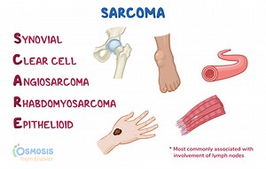 SCARE: Sarcoma Histology Acronym  | Osmosis