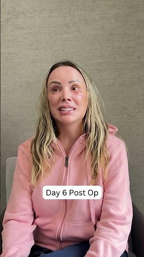Day 6 Post-Op Vertical Restore Facelift Healing & Results