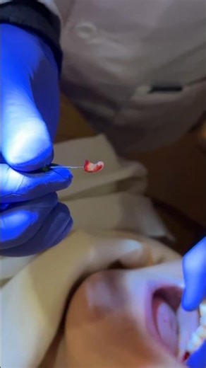 palatal Root tip Extraction With hand file #shorts