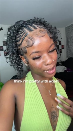 mannnnn i cant wait #fyp #acne #xpushinpretty #whatkevingatessaid️ #acnejourney #clearskin