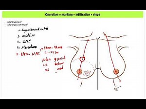 Breast reduction marking - #PlastiBites