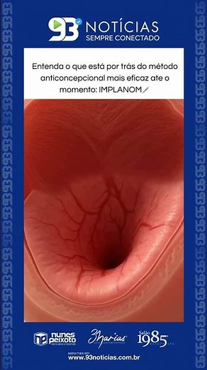 💉🧬 IMPLANON: HOW DOES THE "ARM CONTRACEPTIVE" WORK?