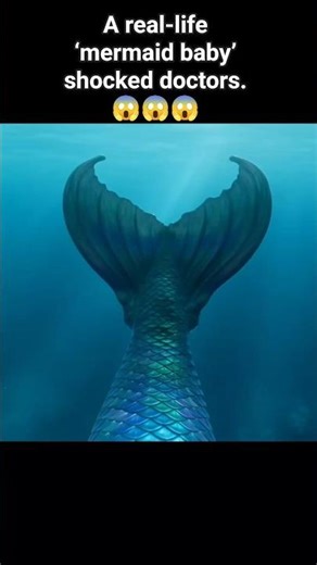 “The Baby Born With Mermaid Legs 😳 | The Rare Mermaid Syndrome Explained #medicalmystery