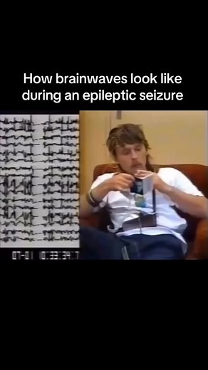 Understanding Brainwaves During an Epileptic Seizure