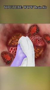 ASMR Remove ants & maggot from infected lip | ASMR Animation treatment #asmr #asmrsound #treatment #removal #care #asmrvideo #asmrgame | WOW Brain