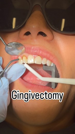 🦷😎Goodbye Gummy Smile, Hello Confidence!😎🦷 Did you know that a gingivectomy can completely transform your smile by reshaping your gum line? If you’ve been self-conscious about excess gum tissue, this simple procedure might be your solution! What to Expect: * ��Quick and comfortable with minimal recovery time * ��Beautifully reshaped gum line that lets your teeth shine * ��Improved oral health by reducing pockets where bacteria can grow A healthy, confident smile is just one step away. Ready 