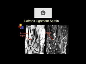 MRI of the Ankle, Part 5 – Ankle Ligaments