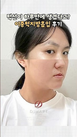 Double Chin Liposuction Review: Get a Defined Jawline in Just One Day! #FacialLiposuction #Double...