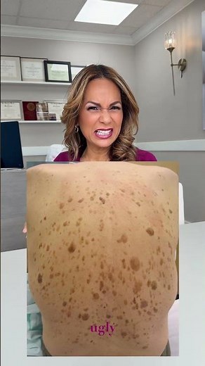 Cancer or Seborrheic Keratosis?? #dermatology #skincare #dermtips #dermatologist