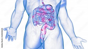 Animation of a colon affected by Crohn's Disease