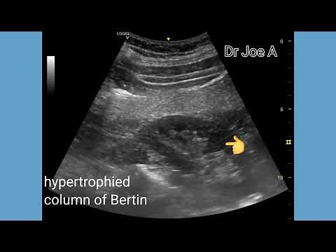Hypertrophied or prominent column of Bertin, Ultrasound and color Doppler video