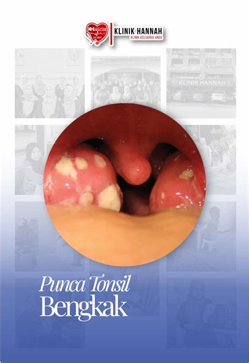Tonsil bengkak boleh sebabkan sakit tekak, susah telan dan demam. Kadang-kadang ia berpunca daripada jangkitan bakteria atau virus. Kalau tonsil sering bengkak atau sakit tekak berulang, elok buat pemeriksaan. Datang Klinik Hannah untuk pemeriksaan tekak #tonsil #tonsilitis #tonsilbengkak #tonsilectomy #sakittekak