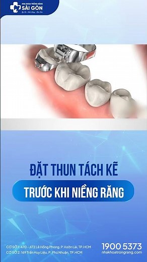 Đặt Thun Tách Kẽ Trước Khi Niềng | Nha Khoa Trồng Răng Sài Gòn #nhakhoatrongrangsaigon #niengrang