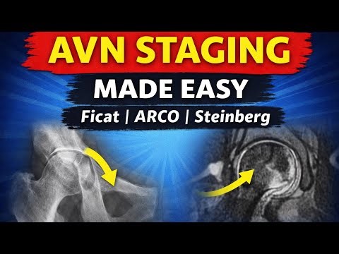 AVN Femoral Head Staging Made Easy | Ficat, ARCO, Steinberg & Kerboul Explained