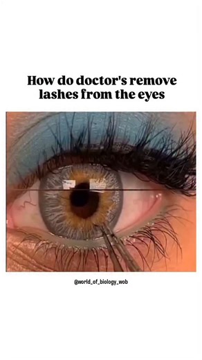World of Biology on Instagram: "Doctors carefully remove eyelashes from the eye using gentle and precise methods to avoid irritation or injury. They first examine the eye under bright light or a slit lamp to locate the lash. If it’s loose, they may flush it out with sterile saline solution. If the eyelash is stuck, they use a moistened cotton swab or fine, sterile tweezers to lift it away carefully. In cases where the lash is trapped under the eyelid, they may gently flip the lid inside out for 