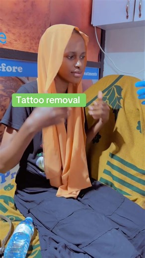 Tattoo laser removal it’s safe and effective