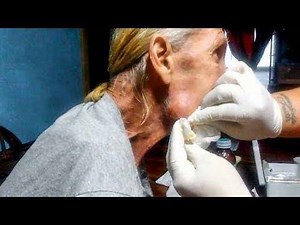 1.1K views · 16 reactions | Cyst Is Popped On Mans Face 2019 Don't forget to like, share & follow to get more videos! | Pimple Popping | Facebook