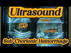 Subchorionic Hemorrhage on Ultrasound | Pregnancy Mysteries: Subchorionic Hematoma Scan