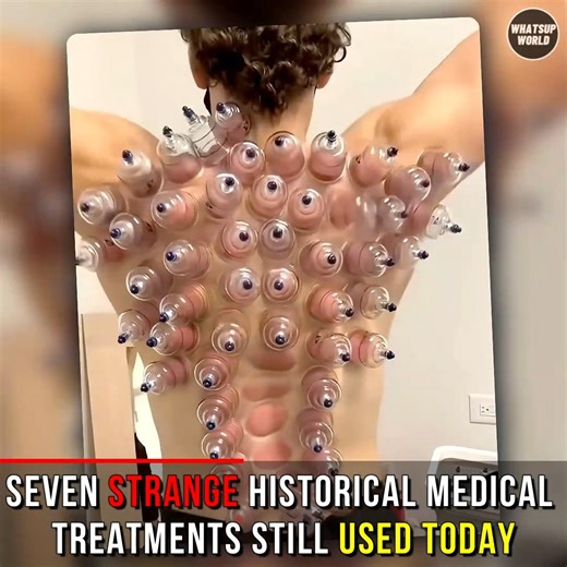 126K views · 2.4K reactions | 7 Weird Medical Treatments From History That People Still Use Today | Whatsup World | Facebook