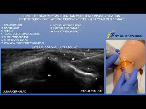 Platelet Rich Plasma Injection/Fenestration a 61 Year Old Female with Lateral Epicondylitis