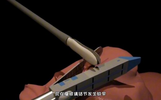 手术就是这么简单，胸腔镜肺结节切除过程，3D演示。。