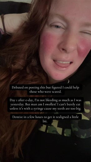 My Denture and Implant Journey: Day 1 Experience