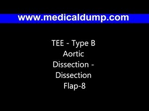Type B Aortic Dissection - TransEsophageal EchoCardiogram (TEE)