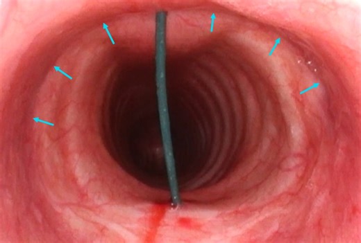 How I Do It: The Transtracheal Approach for Awake Cricopharyngeal Botulinum Toxin Injection